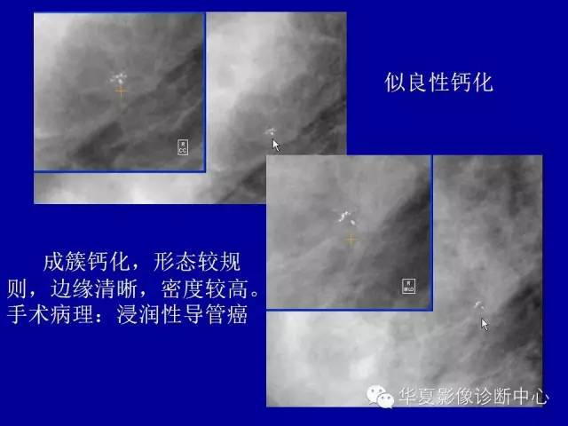 【PPT】乳腺癌的X线诊断