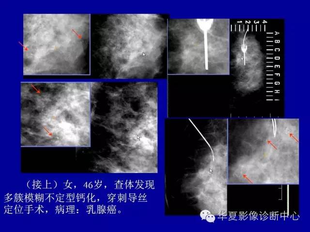 【PPT】乳腺癌的X线诊断