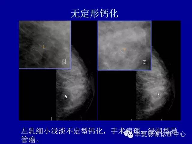【PPT】乳腺癌的X线诊断
