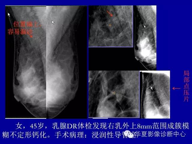 【PPT】乳腺癌的X线诊断