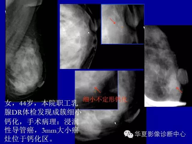 【PPT】乳腺癌的X线诊断
