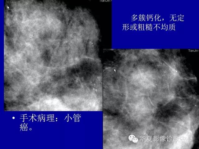 【PPT】乳腺癌的X线诊断