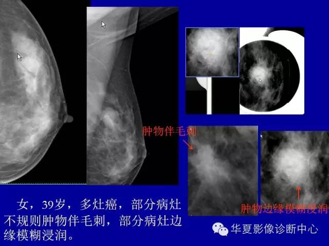 【PPT】乳腺癌的X线诊断