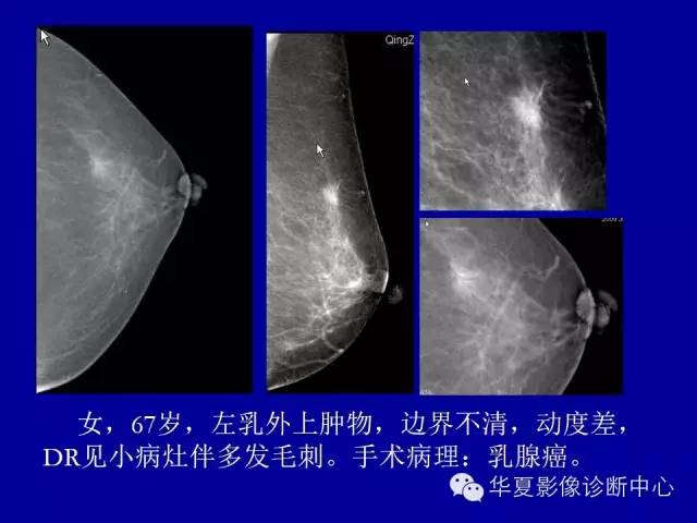 【PPT】乳腺癌的X线诊断