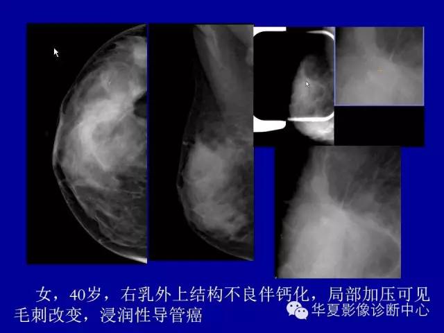 【PPT】乳腺癌的X线诊断