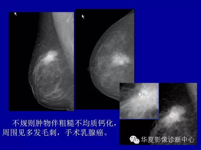 【PPT】乳腺癌的X线诊断