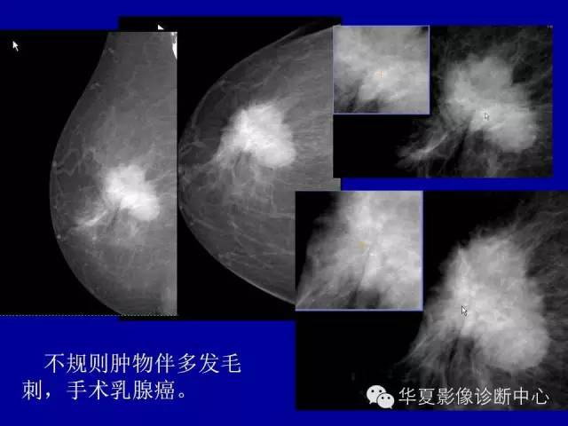 【PPT】乳腺癌的X线诊断