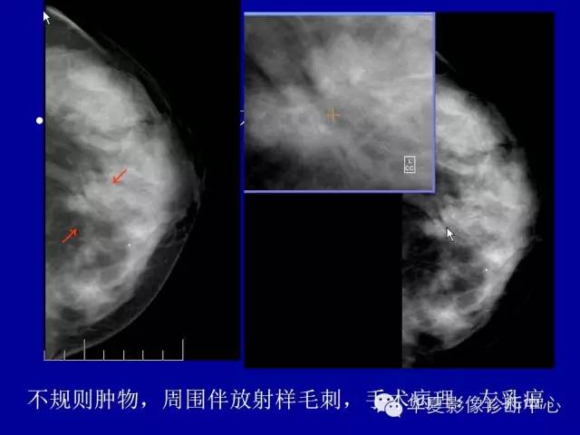 【PPT】乳腺癌的X线诊断