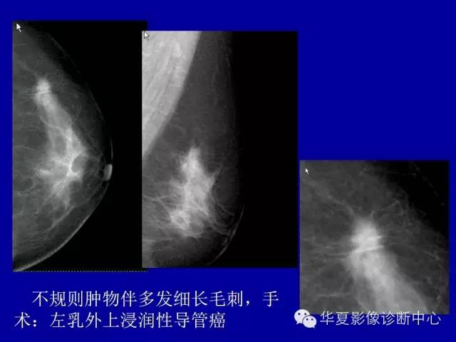 【PPT】乳腺癌的X线诊断
