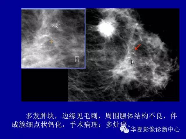 【PPT】乳腺癌的X线诊断