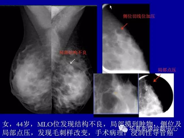 【PPT】乳腺癌的X线诊断