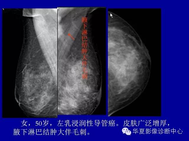 【PPT】乳腺癌的X线诊断