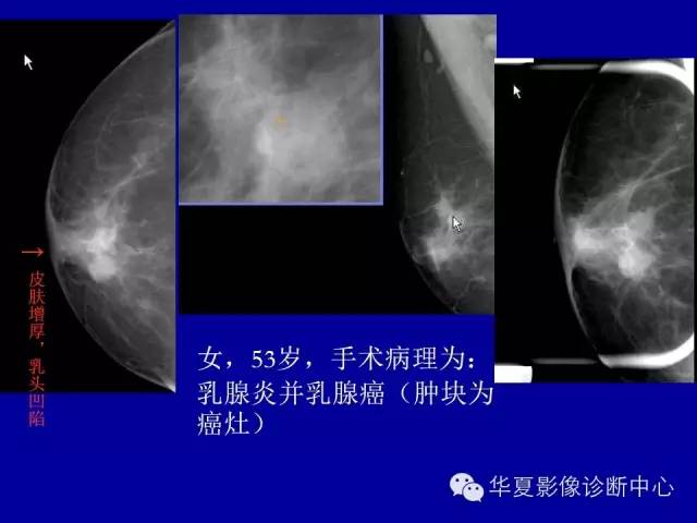 【PPT】乳腺癌的X线诊断