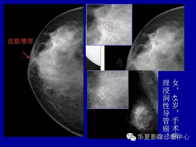【PPT】乳腺癌的X线诊断