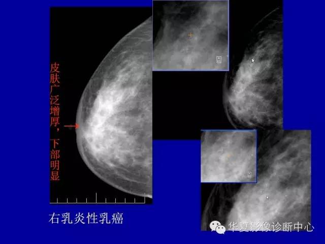 【PPT】乳腺癌的X线诊断