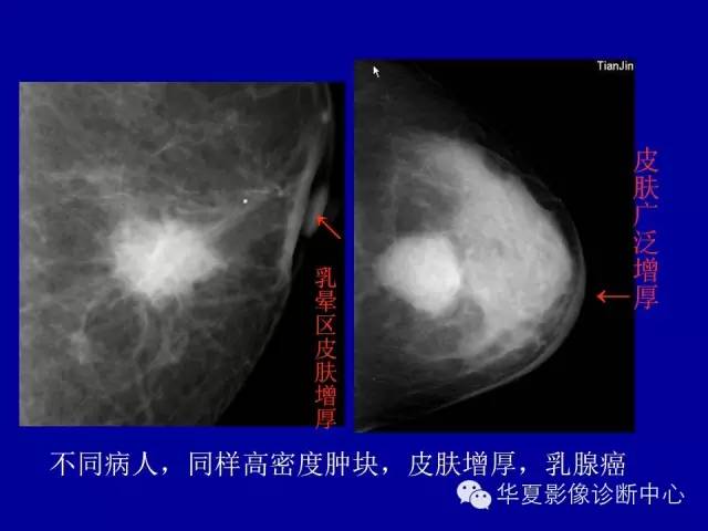 【PPT】乳腺癌的X线诊断