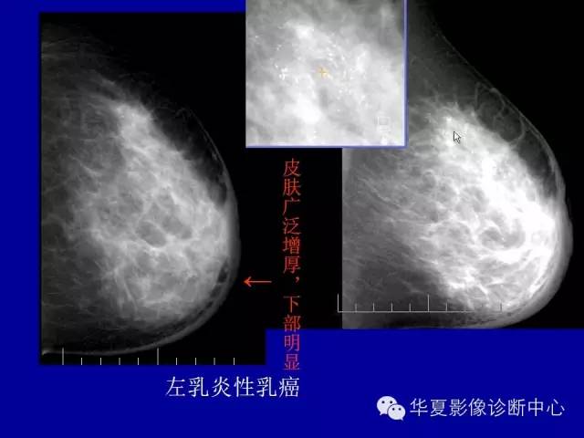 【PPT】乳腺癌的X线诊断