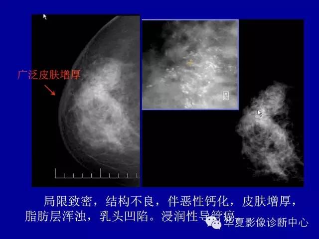 【PPT】乳腺癌的X线诊断