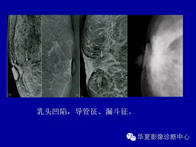 【PPT】乳腺癌的X线诊断