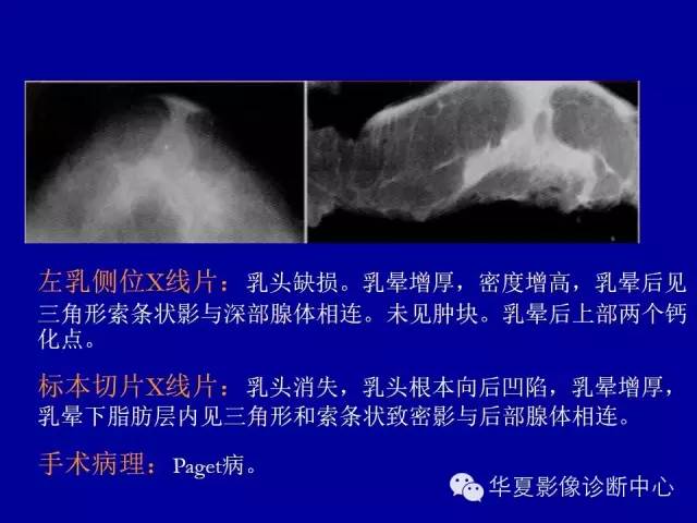 【PPT】乳腺癌的X线诊断