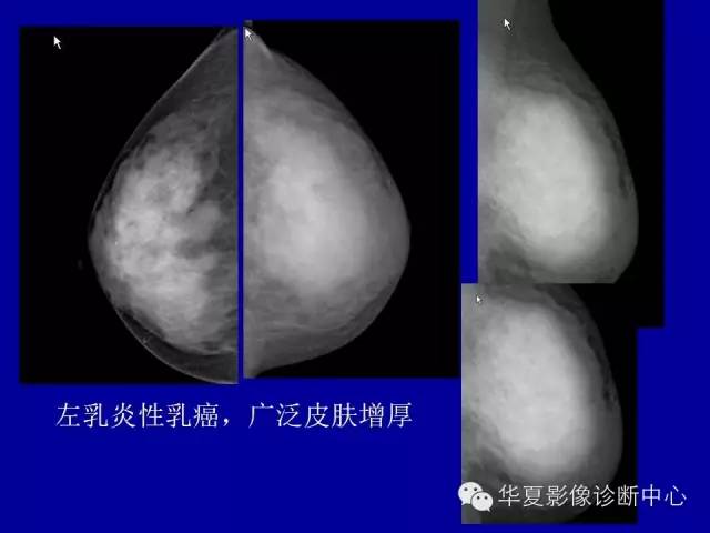 【PPT】乳腺癌的X线诊断