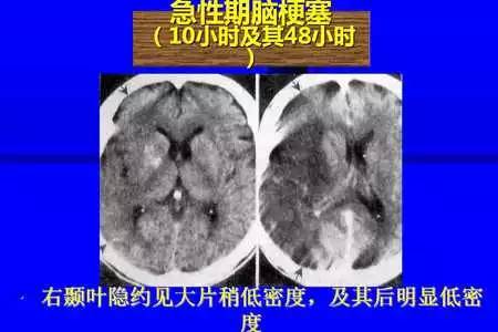 脑梗塞的CT/MRI诊断