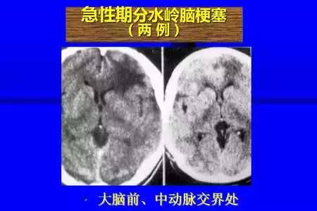 脑梗塞的CT/MRI诊断