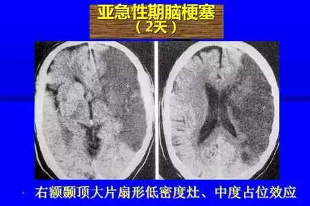 脑梗塞的CT/MRI诊断