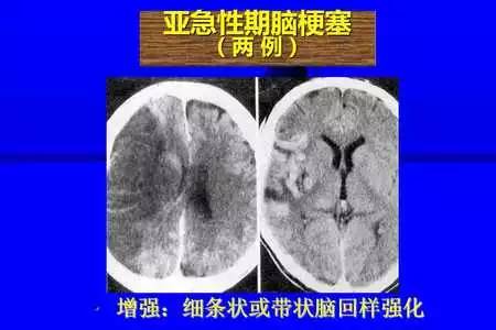 脑梗塞的CT/MRI诊断