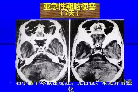 脑梗塞的CT/MRI诊断
