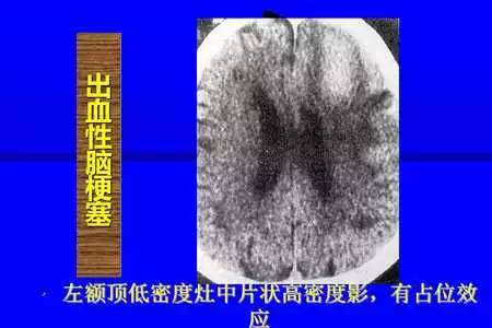 脑梗塞的CT/MRI诊断