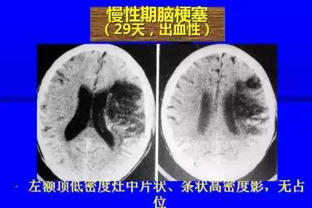 脑梗塞的CT/MRI诊断