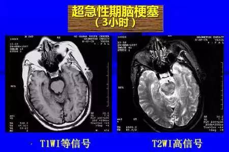 脑梗塞的CT/MRI诊断