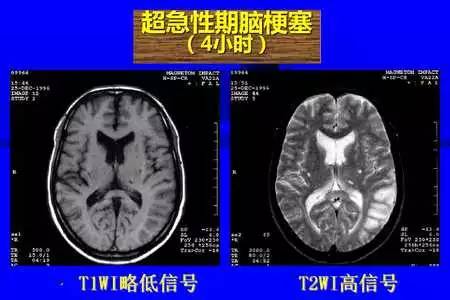 脑梗塞的CT/MRI诊断