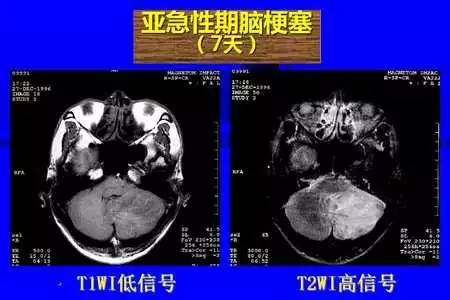 脑梗塞的CT/MRI诊断
