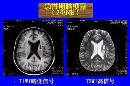 脑梗塞的CT/MRI诊断