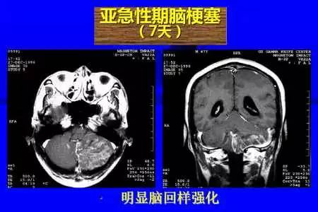 脑梗塞的CT/MRI诊断