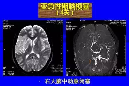 脑梗塞的CT/MRI诊断
