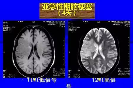 脑梗塞的CT/MRI诊断