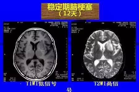 脑梗塞的CT/MRI诊断