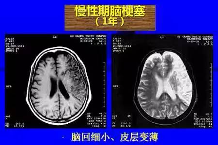 脑梗塞的CT/MRI诊断