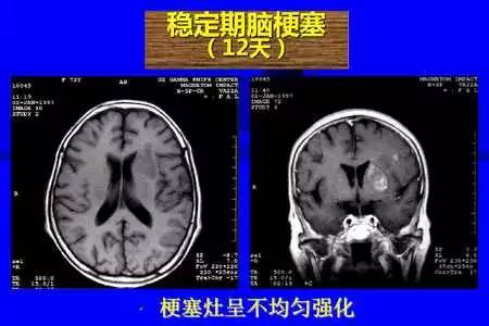 脑梗塞的CT/MRI诊断