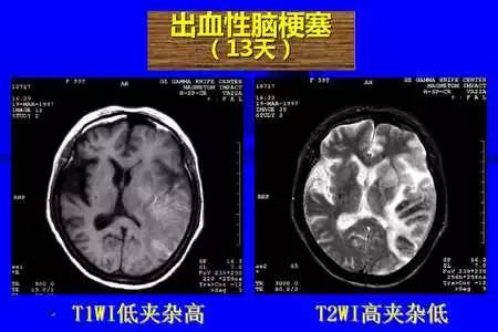 脑梗塞的CT/MRI诊断