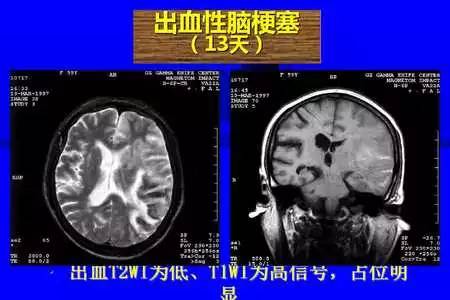 脑梗塞的CT/MRI诊断