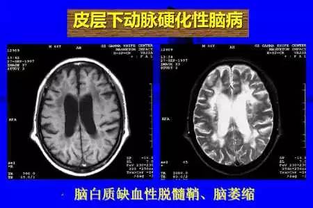 脑梗塞的CT/MRI诊断