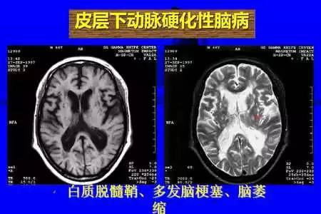 脑梗塞的CT/MRI诊断
