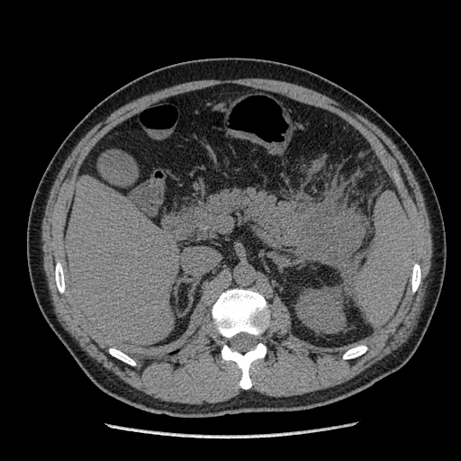 【病例】胰腺尾部坏死性胰腺炎1例CT影像表现 【病例】胰腺尾部坏死性胰腺炎1例CT影像表现