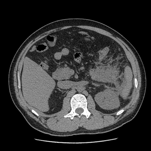 【病例】胰腺尾部坏死性胰腺炎1例CT影像表现 【病例】胰腺尾部坏死性胰腺炎1例CT影像表现
