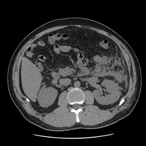 【病例】胰腺尾部坏死性胰腺炎1例CT影像表现 【病例】胰腺尾部坏死性胰腺炎1例CT影像表现