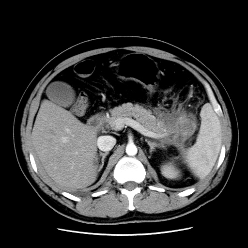 【病例】胰腺尾部坏死性胰腺炎1例CT影像表现 【病例】胰腺尾部坏死性胰腺炎1例CT影像表现